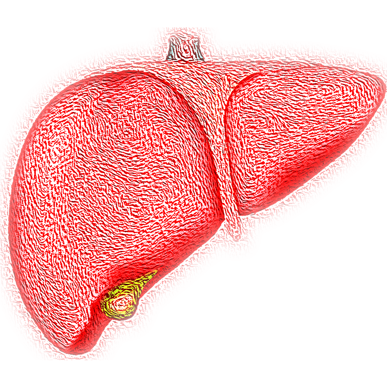 Hepatitis A Outbreak Cumbernauld